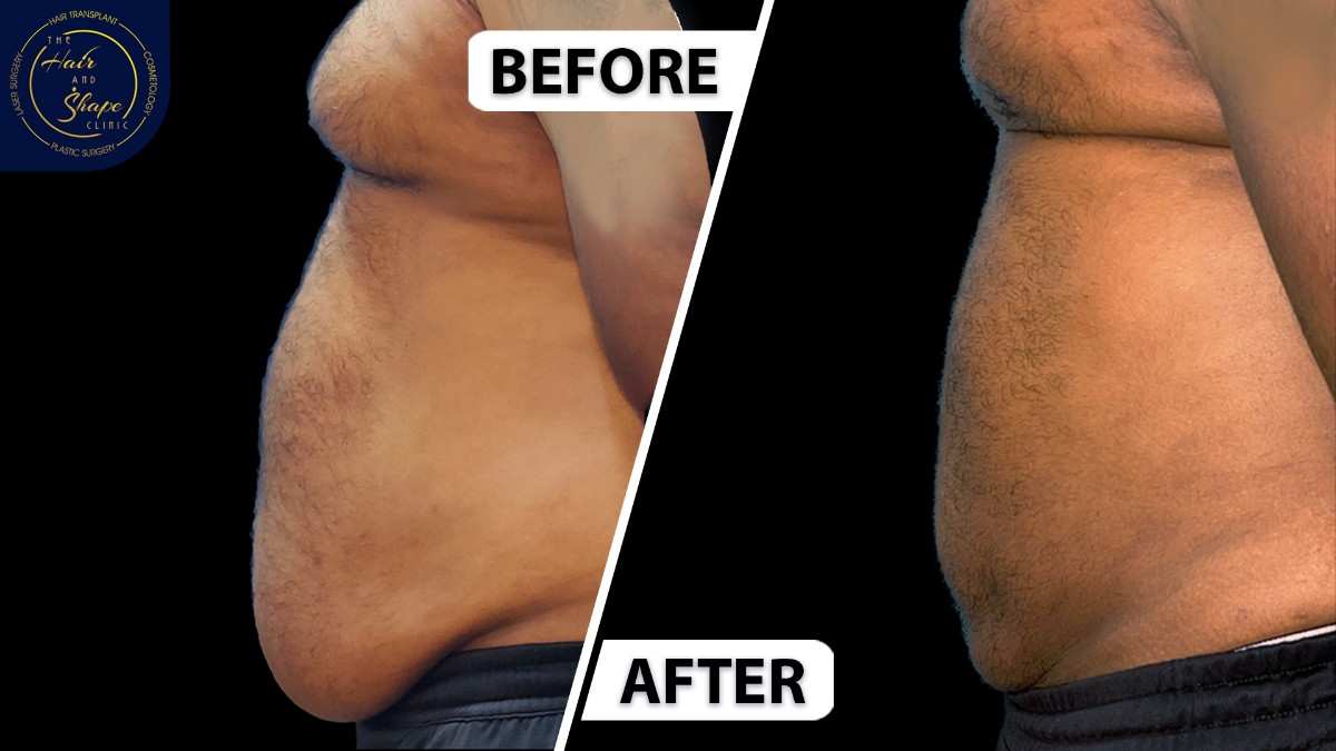 Liposuction result5